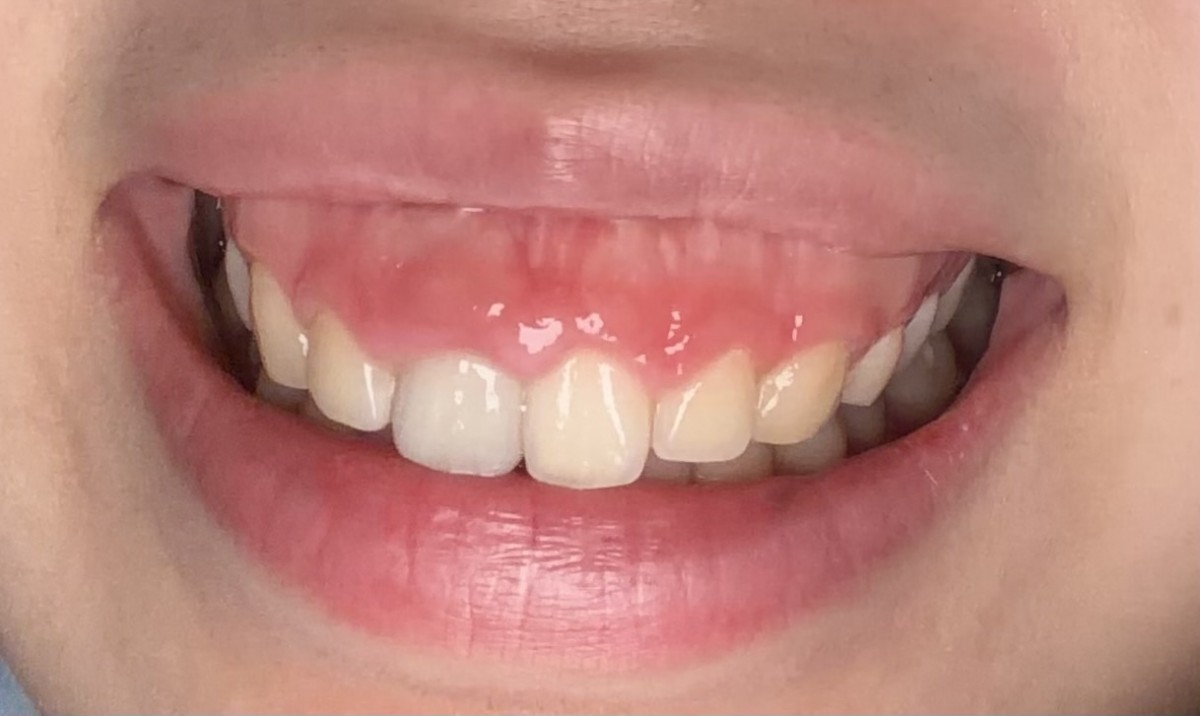 활짝 웃었을 때